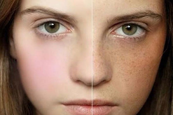 Loại bỏ hoàn toàn melanin khỏi cơ thể sẽ hết nám da?